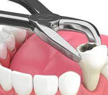 Tooth Extraction