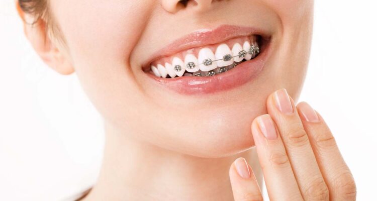 The Right Braces for You